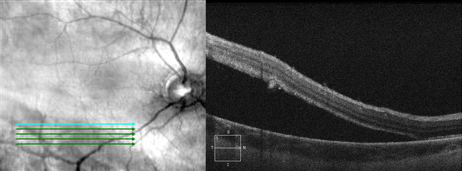 Optical coherence tomography through the inferior right posterior pole demonstrates the retinal detachment.