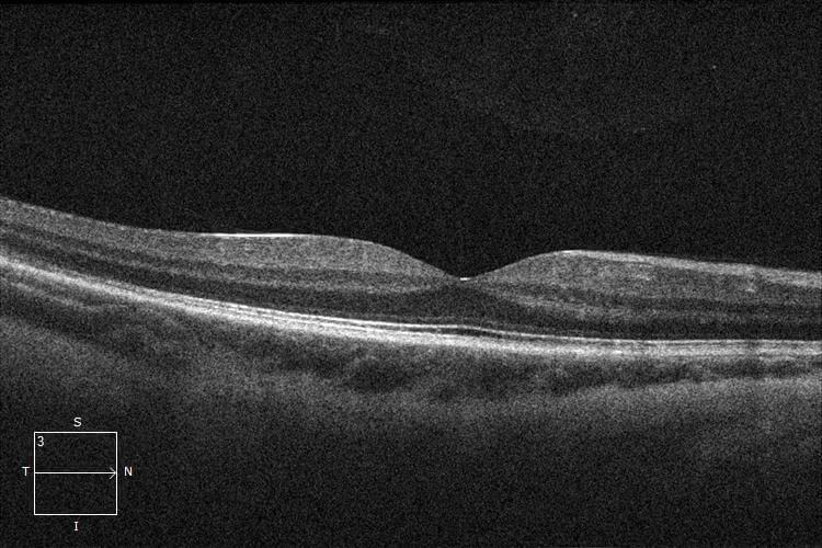 Optical coherence tomography through the right macula demonstrates foveal attachment (“macula-on”).