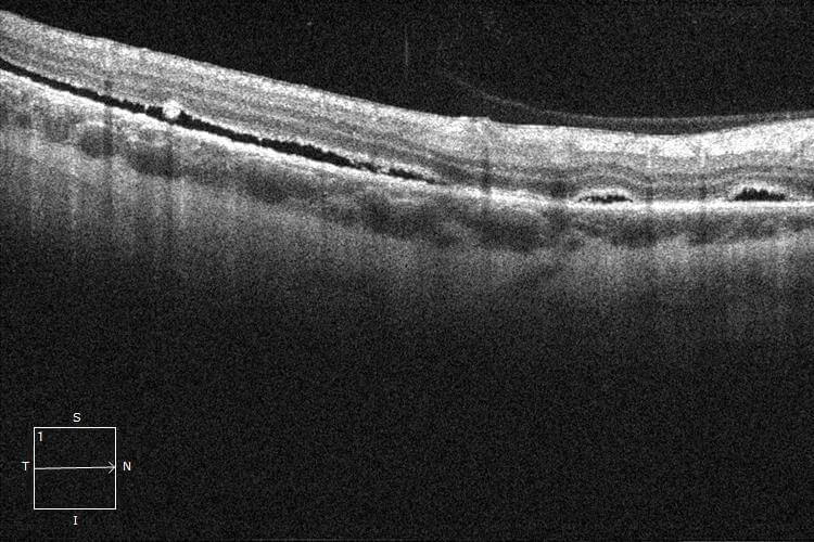 One month post-operative optical coherence tomography demonstrated mild residual subretinal fluid. Note the areas of confluent fluid (left) and discrete blebs of subretinal fluid (right).