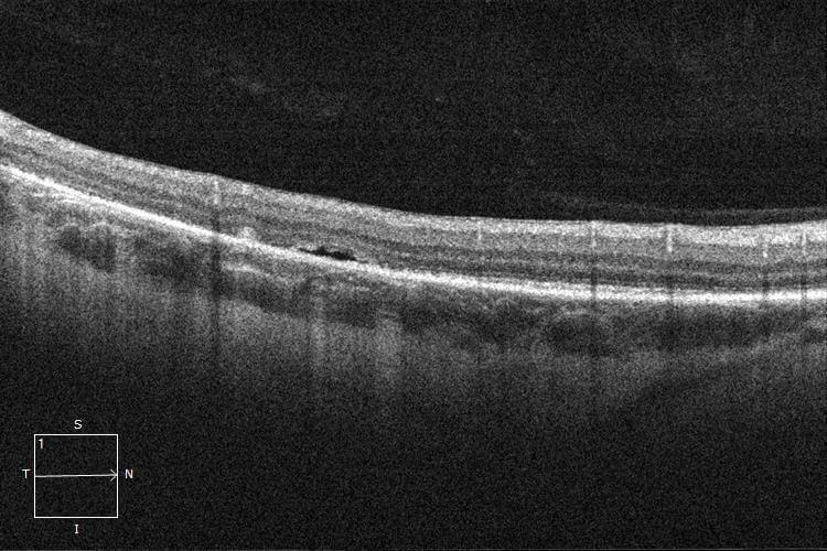 Six-month post-operative optical coherence tomography demonstrates almost complete resolution of the subretinal fluid.