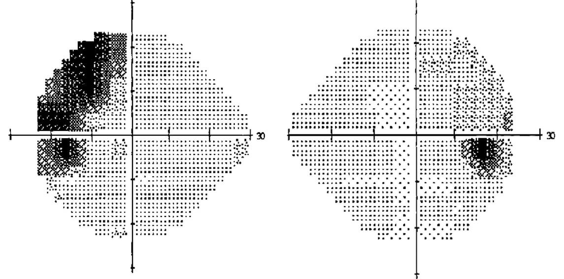 Humphrey visual fields six weeks following surgery.
