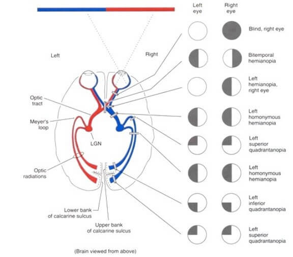 Figure 4.Typical visual field loss from lesions along the visual pathway. Reproduced from http://slideplayer.com/slide/4480902/