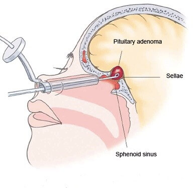 Figure 5. Trans-sphenoidal approach to pituitary tumour excision. Reproduced from http://neurosurgery.med.u-tokai.ac.jp/en/patients/pa/treatment.html