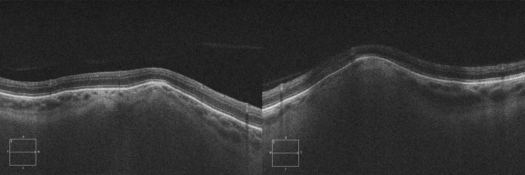 Optical coherence tomography of the lesions shows an undulating elevation of the sclera with thinning of the overlying choroid. The retina is normal.