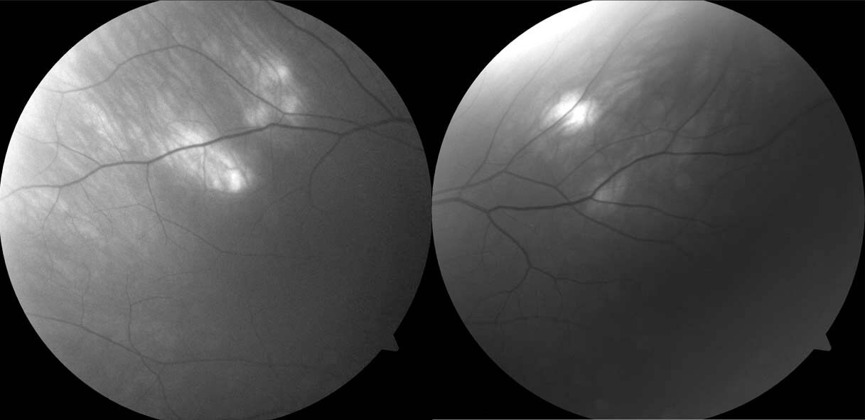 Red-free photography highlights the subretinal lesions.