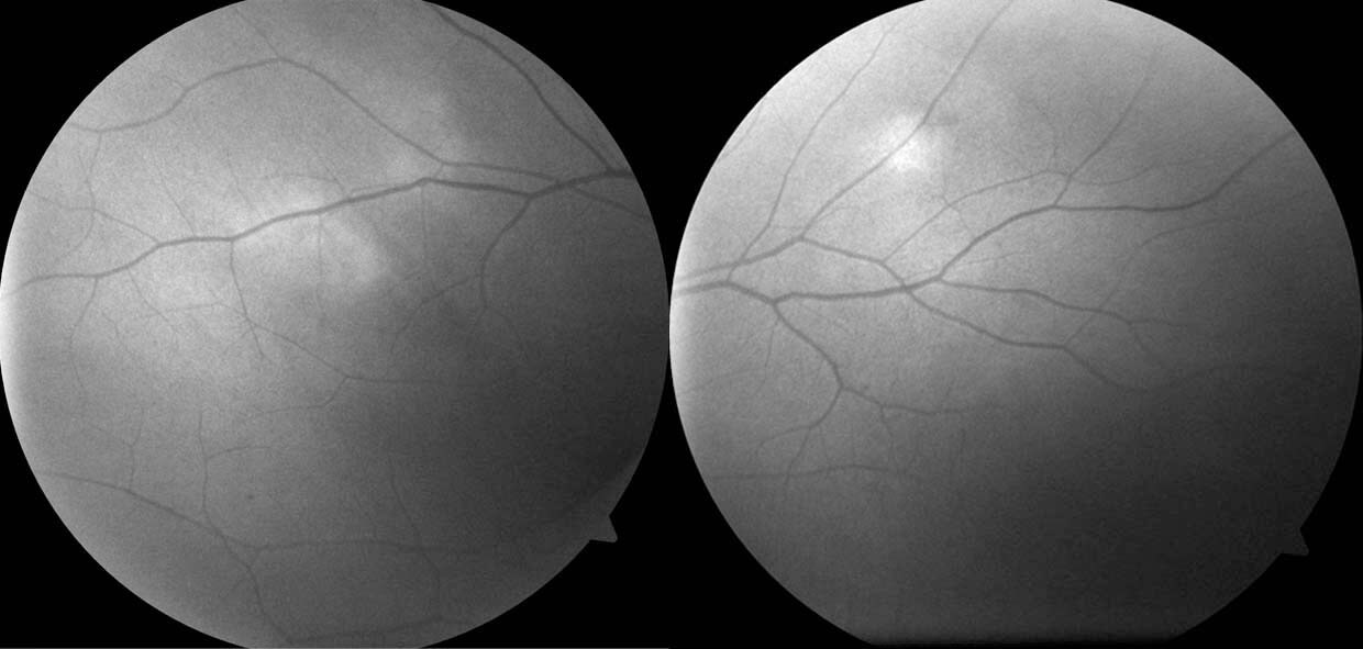 The nodules are mildly hyperautofluorescent.