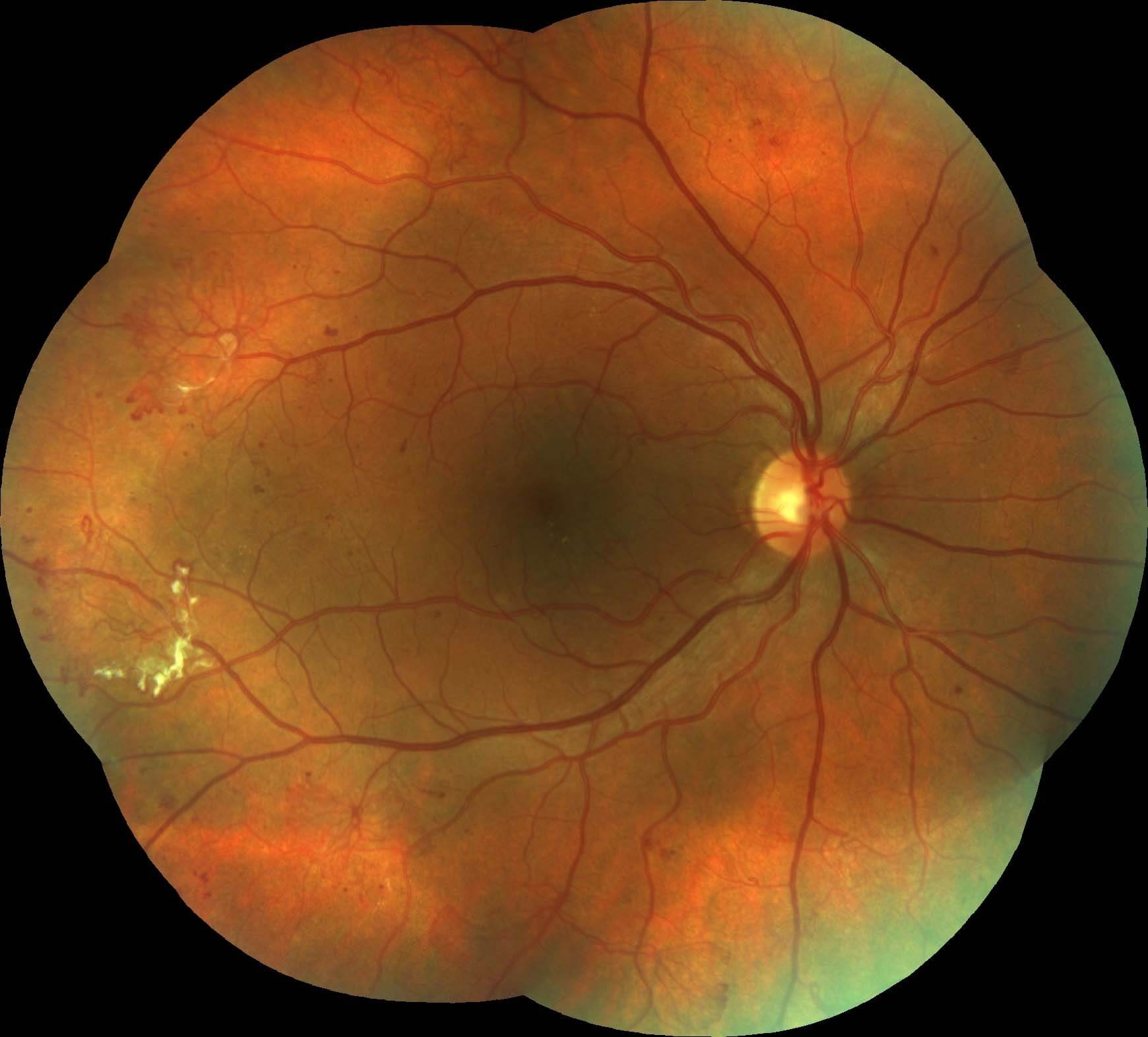Right colour photography demonstrates neovascularization elsewhere and preretinal fibrosis.