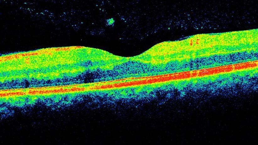 Optical coherence tomography of the left macula does not demonstrate any oedema.