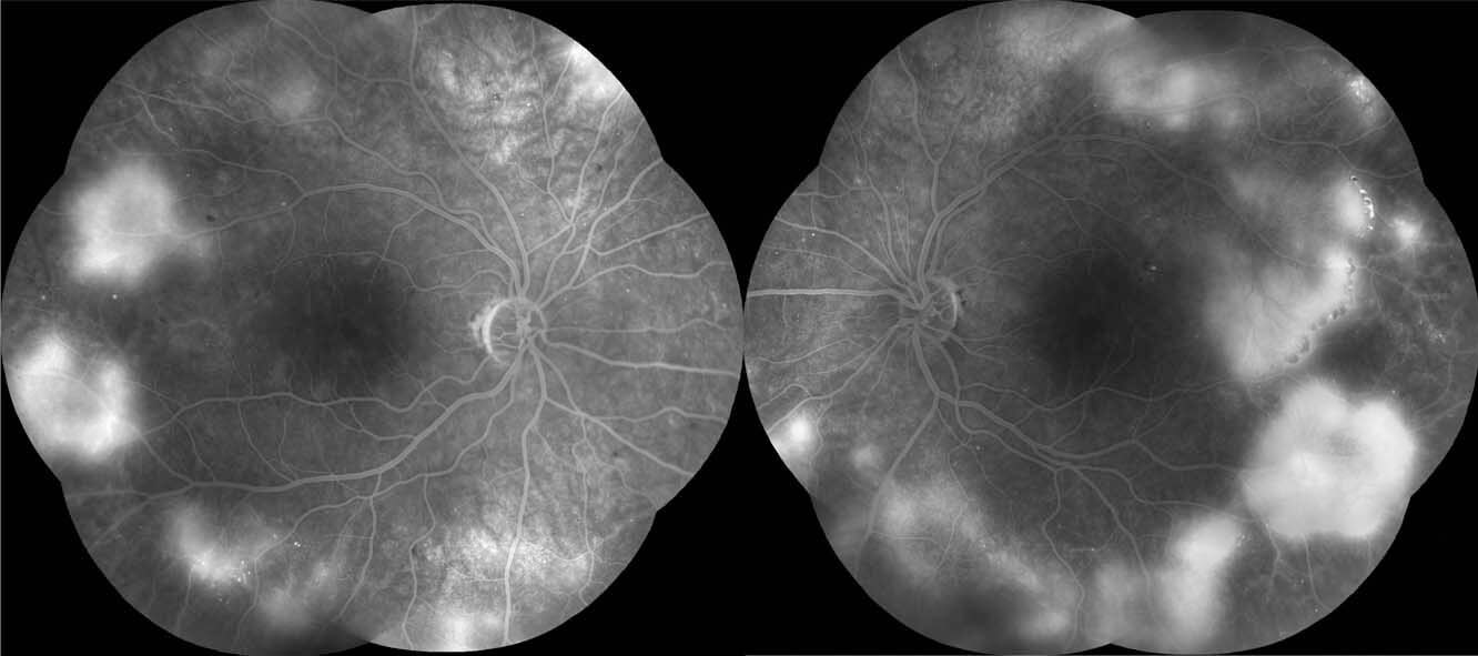 Fundus fluorescein angiography (FFA) demonstrates hyperfluorescence associated with the areas of neovascularization elsewhere. There was no neovascularization of the disc. The foveal avascular zones are irregular as a result of some macular ischaemia.