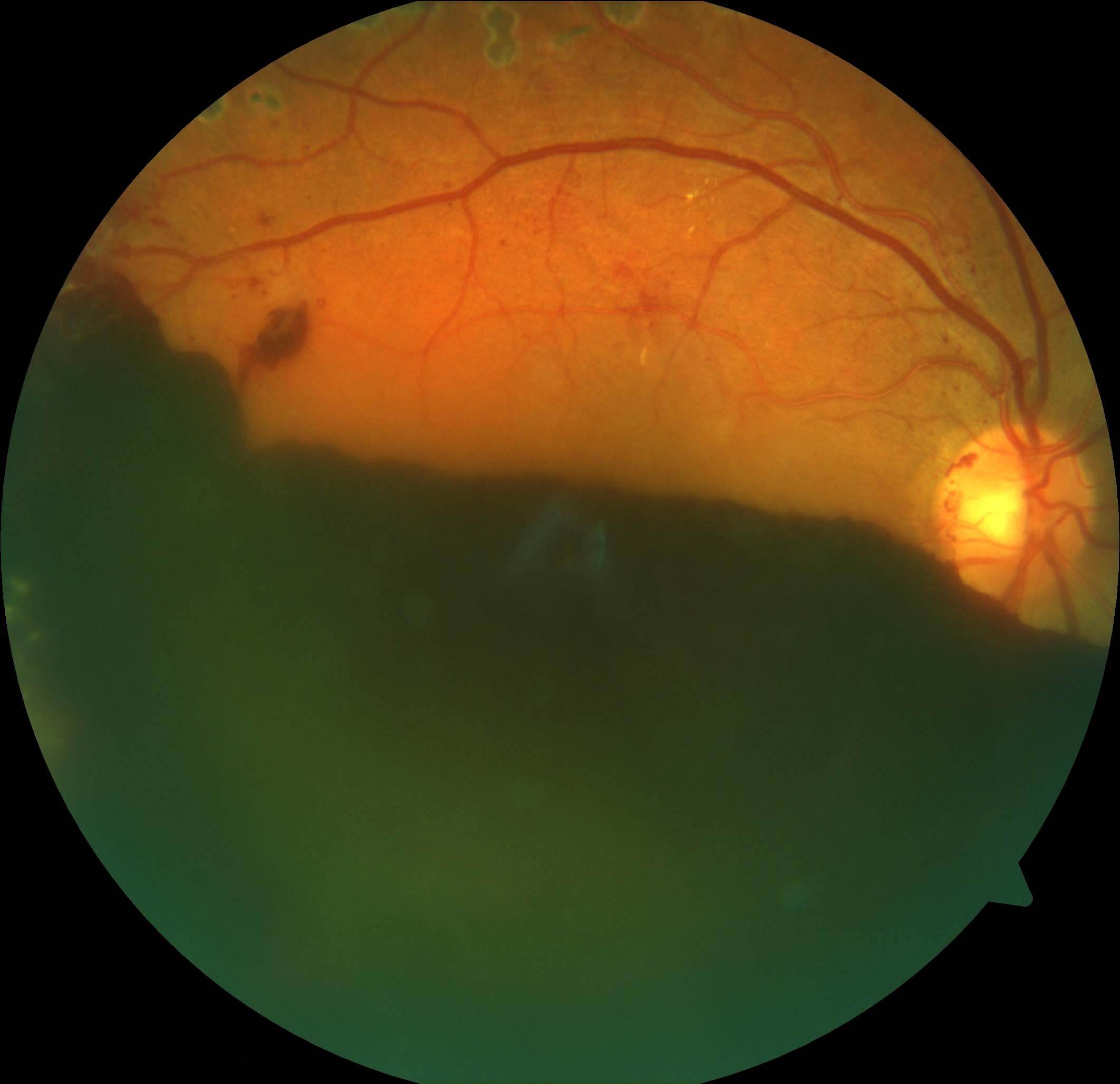 Despite panretinal photocoagulation laser treatment in the right eye the patient suffered a large preretinal haemorrhage. Some laser burns can be seen just outside the superior arcade.