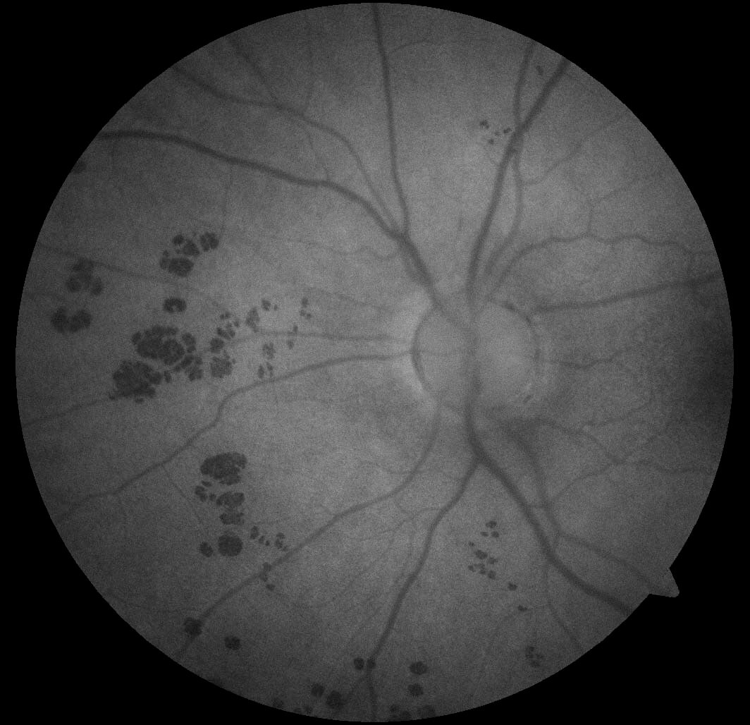  Left fundus autofluorescence demonstrates the lesions to be homogenously hypoautofluorescent.