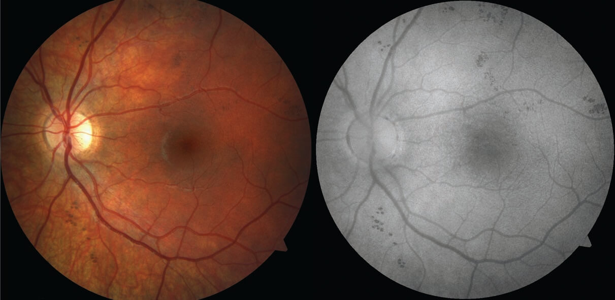 Left colour and autofluorescence images of the posterior pole demonstrating the lesions to be less prominent and smaller.