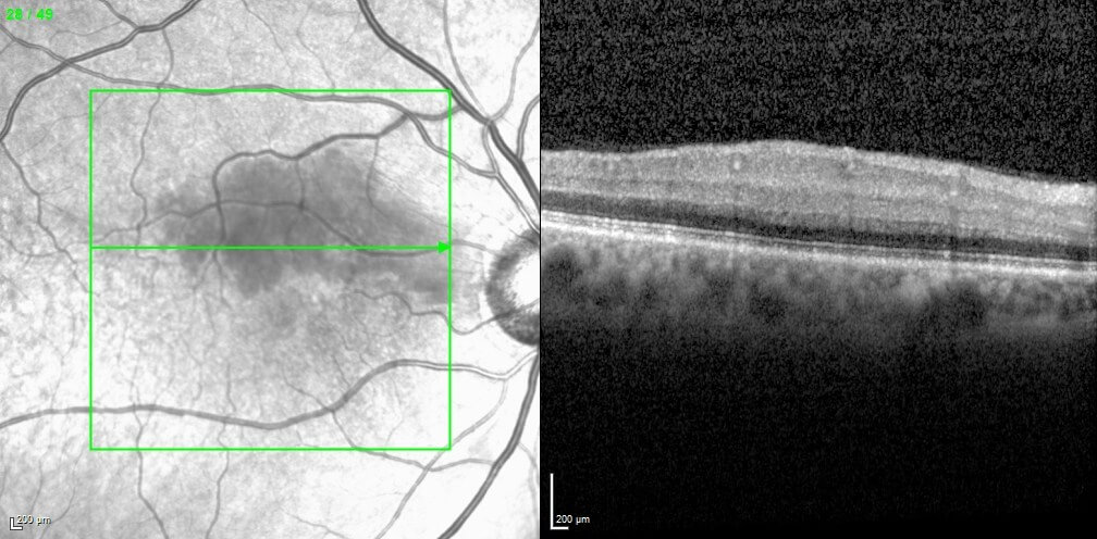  Optical coherence tomography of the right macula shows inner retinal thickening due to oedema.