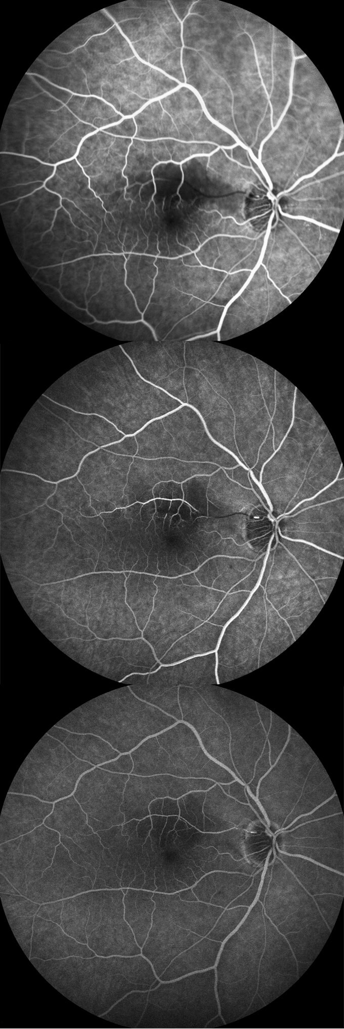 Fluorescein angiography (early to late, top to bottom) shows occlusion of the right cilioretinal artery, which fills with dye from retrograde flow in the late phase.