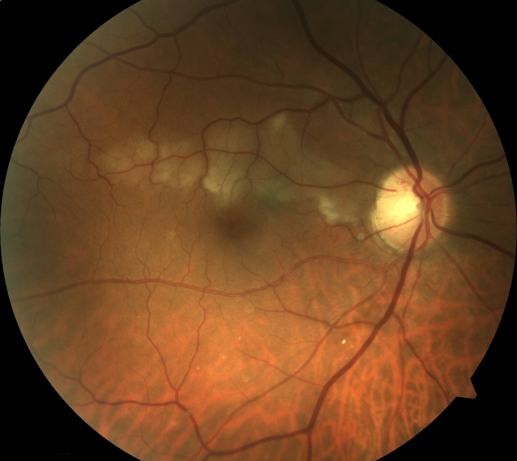 Two weeks after the initial occlusion there is confluence and contraction of the area of retinal pallor.