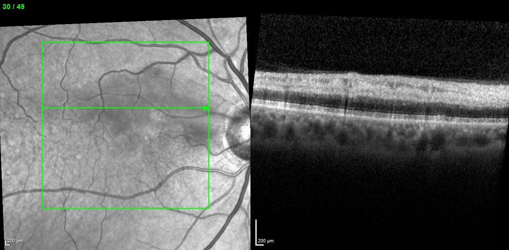 Two weeks after the initial occlusion there is less retinal oedema on optical coherence imaging.