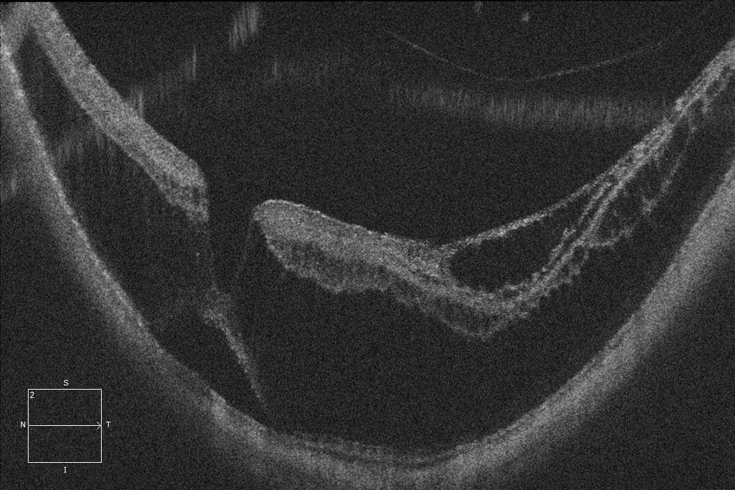 Optical coherence tomography through the left fovea demonstrating a staphyloma, retinoschisis and limited foveal detachment. Note the thicker inner retinal layer, thinner outer retinal layer, intervening bridging columns and epiretinal membrane.