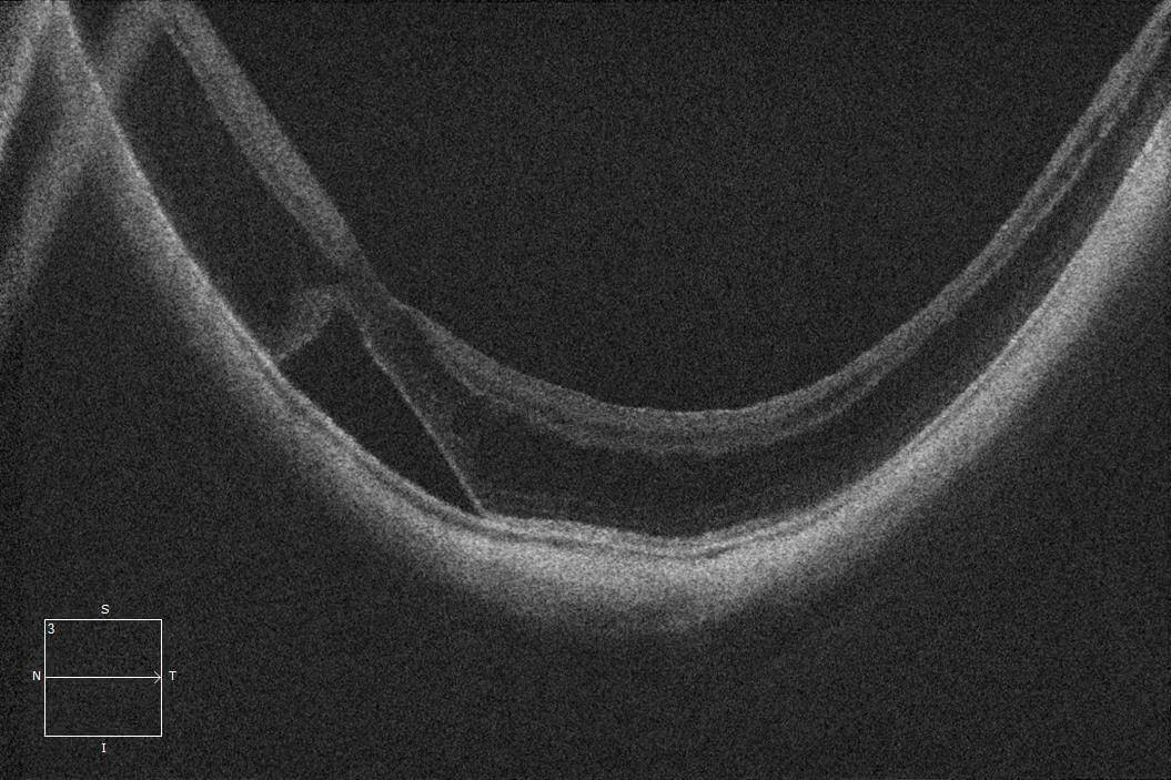 One month postoperative OCT demonstrating relief of the traction and an improvement in the macular architecture.