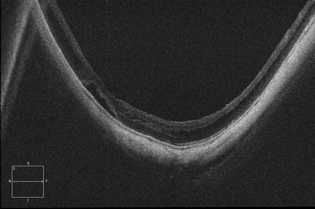 Three month postoperative OCT demonstrating further resolution of the retinoschisis and foveal detachment.