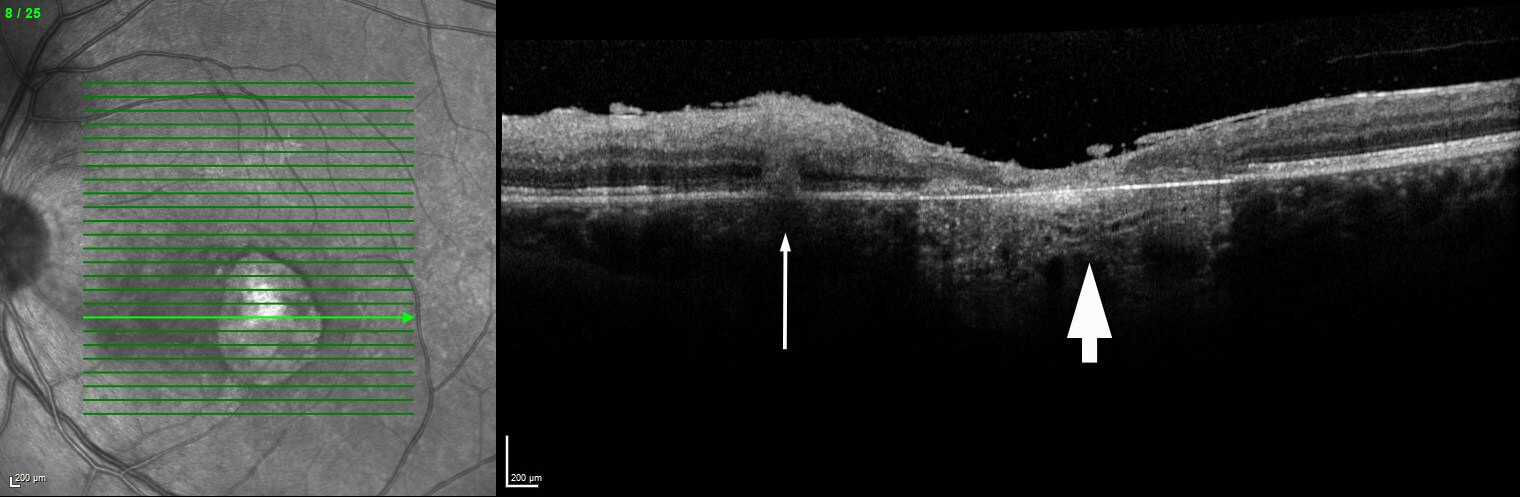 Optical coherence tomography demonstrating active chorioretinitis (thin arrow) and adjacent scar (thick arrow).