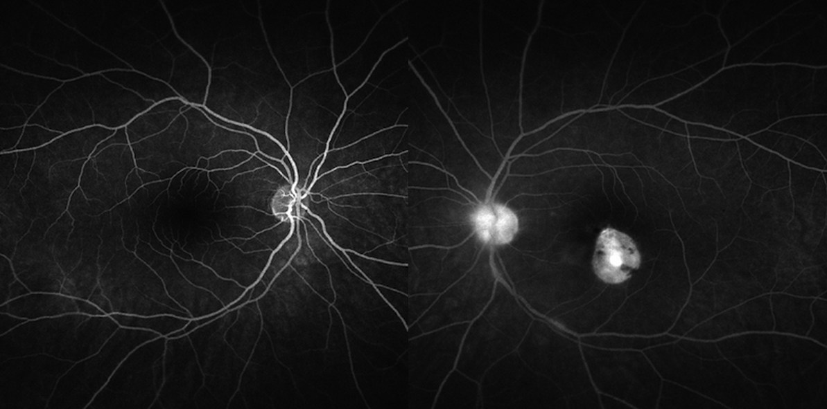 Fluorescein angiography shows left disc leak and inferior periphlebitis.