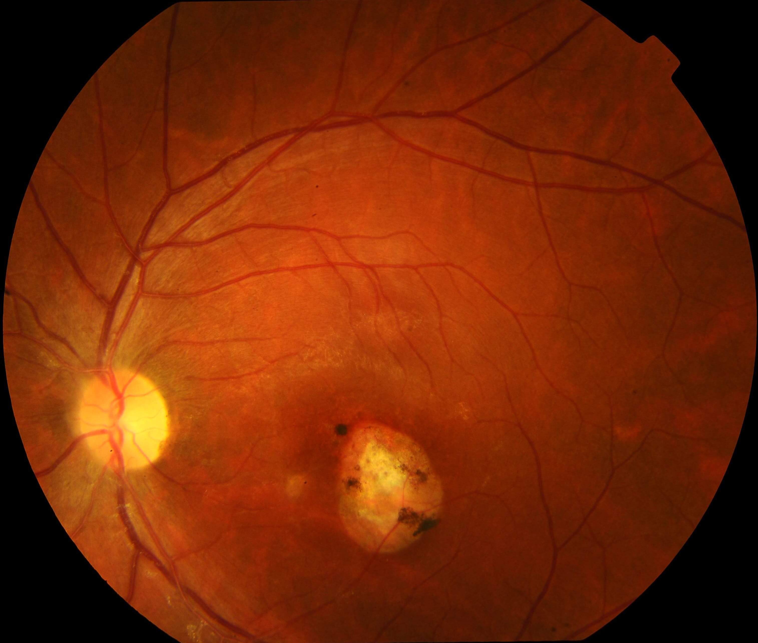 Resolution of vitritis and chorioretinitis at conclusion of treatment.