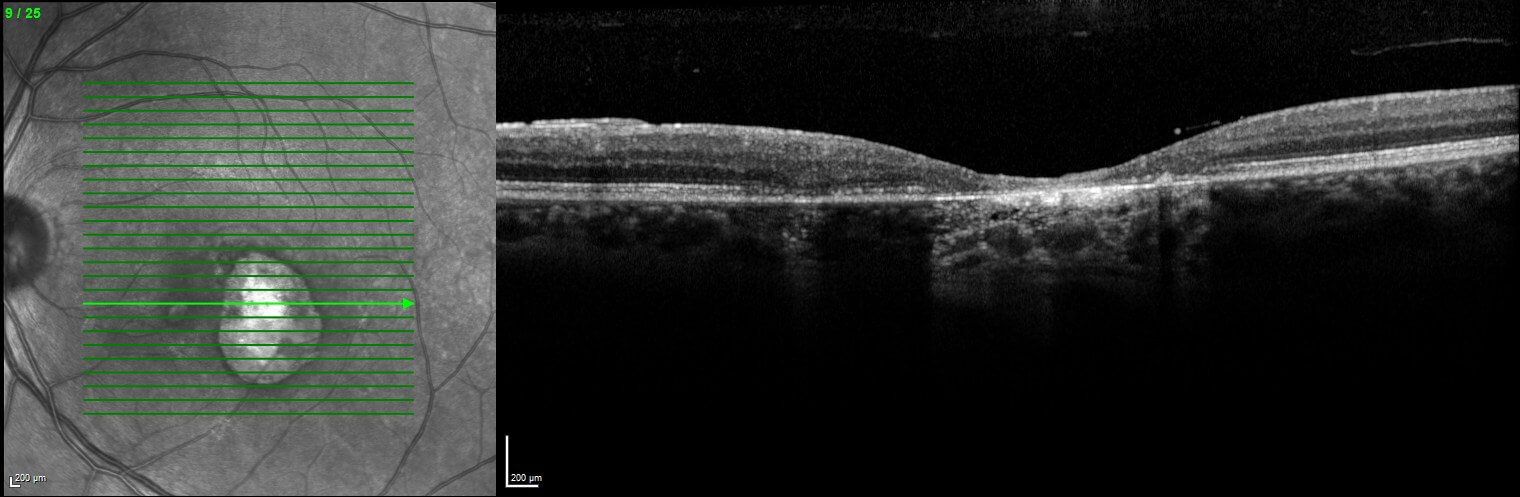 Optical coherence tomography demonstrating resolution of the chorioretinitis.