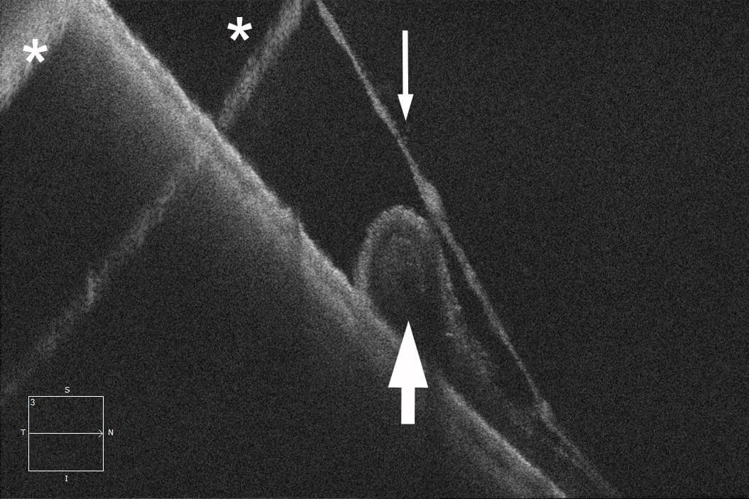 Optical coherence tomography of the far peripheral retinal periphery. There is splitting of the retina into two layers. The thicker outer retina has a rolled edge at the margin of an outer retinal hole (thick arrow), whilst the thinner inner retina continues above this (thin arrow). Artefactual reflections of the inner retinal layer and retinal pigment epithelium are marked by asterixes.