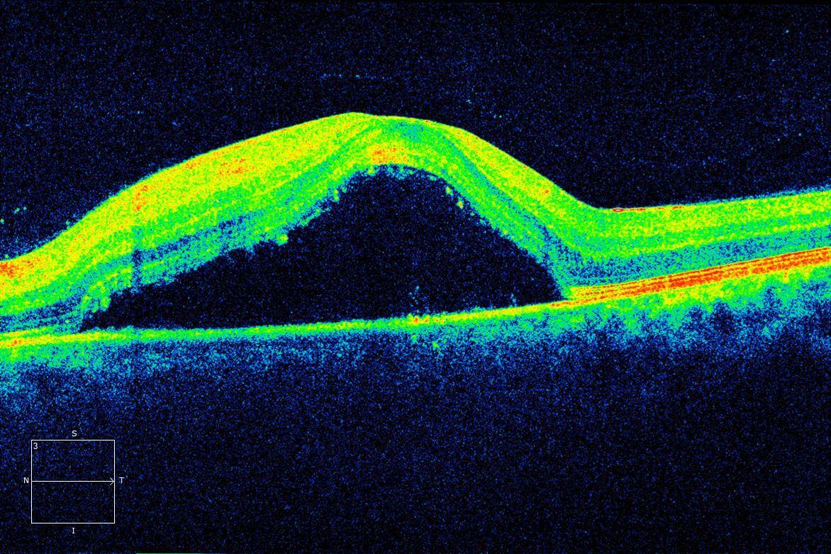 Left optical coherence tomography (horizontal raster scan) through the macula at presentation demonstrates a serous retinal detachment.