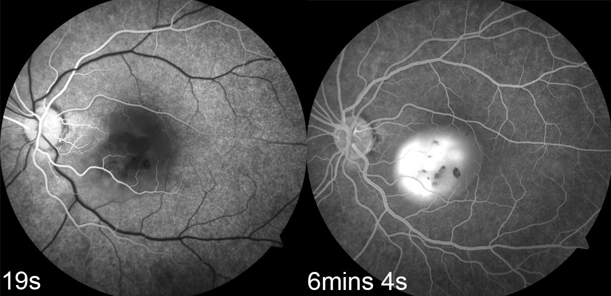 Left fundus fluorescein angiography showing intense hyperfluorescence within the area of the serous retinal detachment.