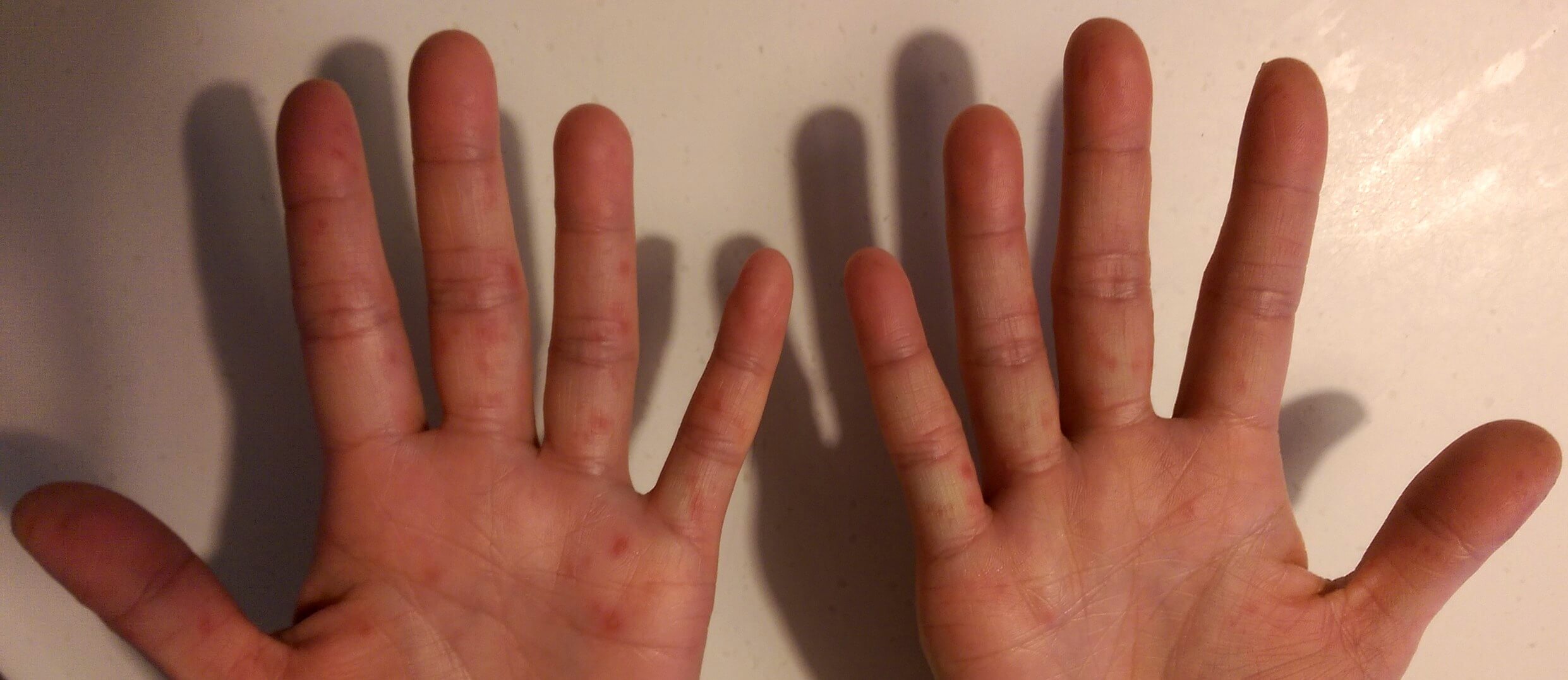 Photograph demonstrating papules on the hands seen in Hand, Foot and Mouth disease.