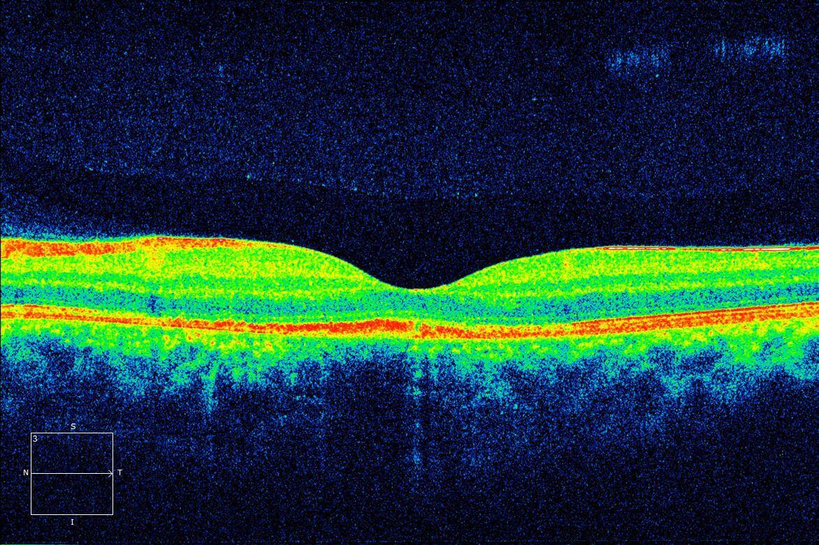 Two weeks following presentation, the subretinal fluid had resolved spontaneously. Hyper-reflectivity was seen under the fovea at the level of the retinal pigment epithelium. There was interruption of the ellipsoid layer but preservation of the external limiting membrane.
