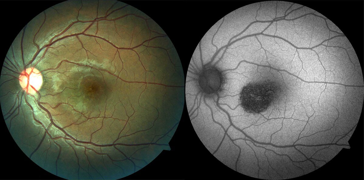 At one year following presentation there is retinal pigment epithelial disturbance within the area of the previous serous retinal detachment (left). This corresponds with an area of fundus hypoautofluoresence (right).