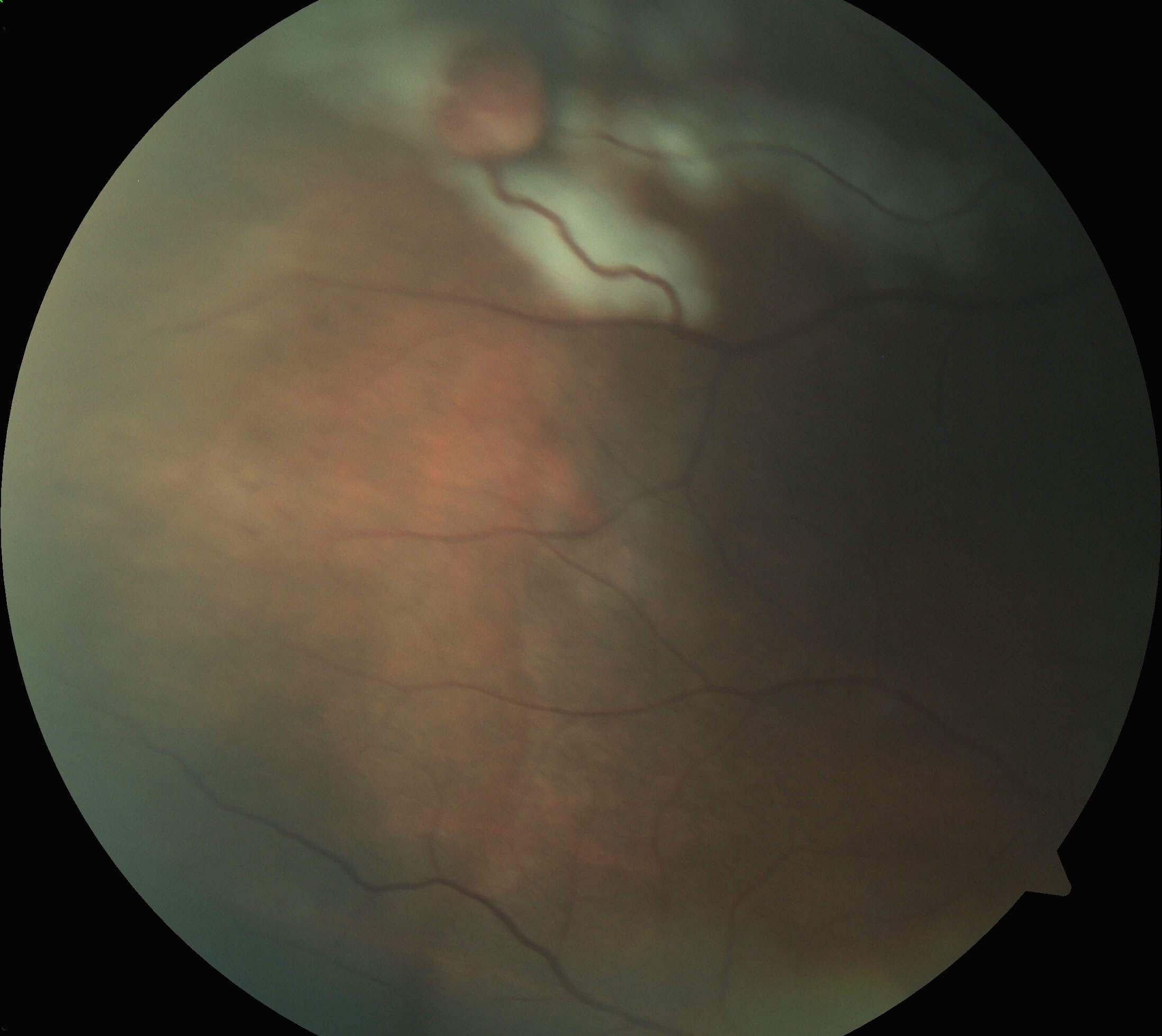 Colour fundus photograph immediately following argon laser photocoagulation. The laser marks are seen in white.