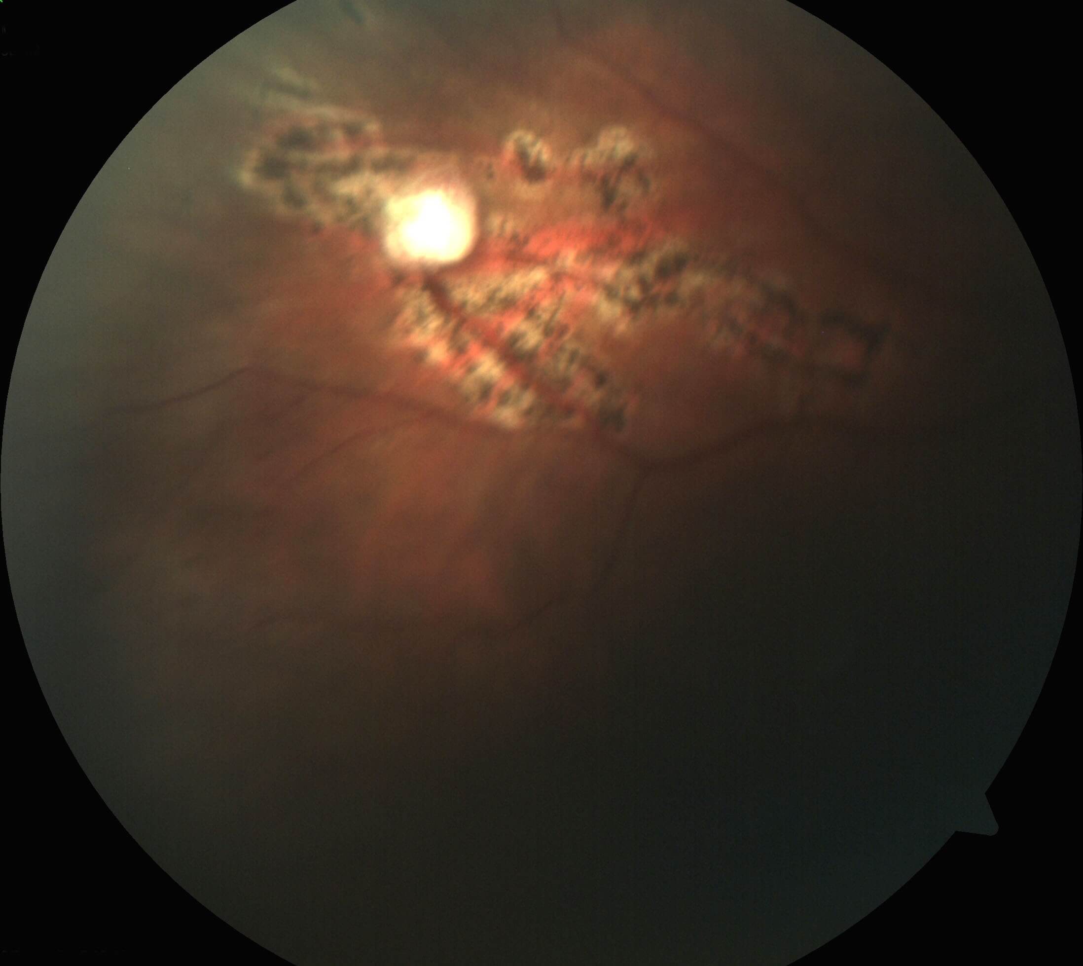 Colour fundus photograph two weeks post laser photocoagulation.