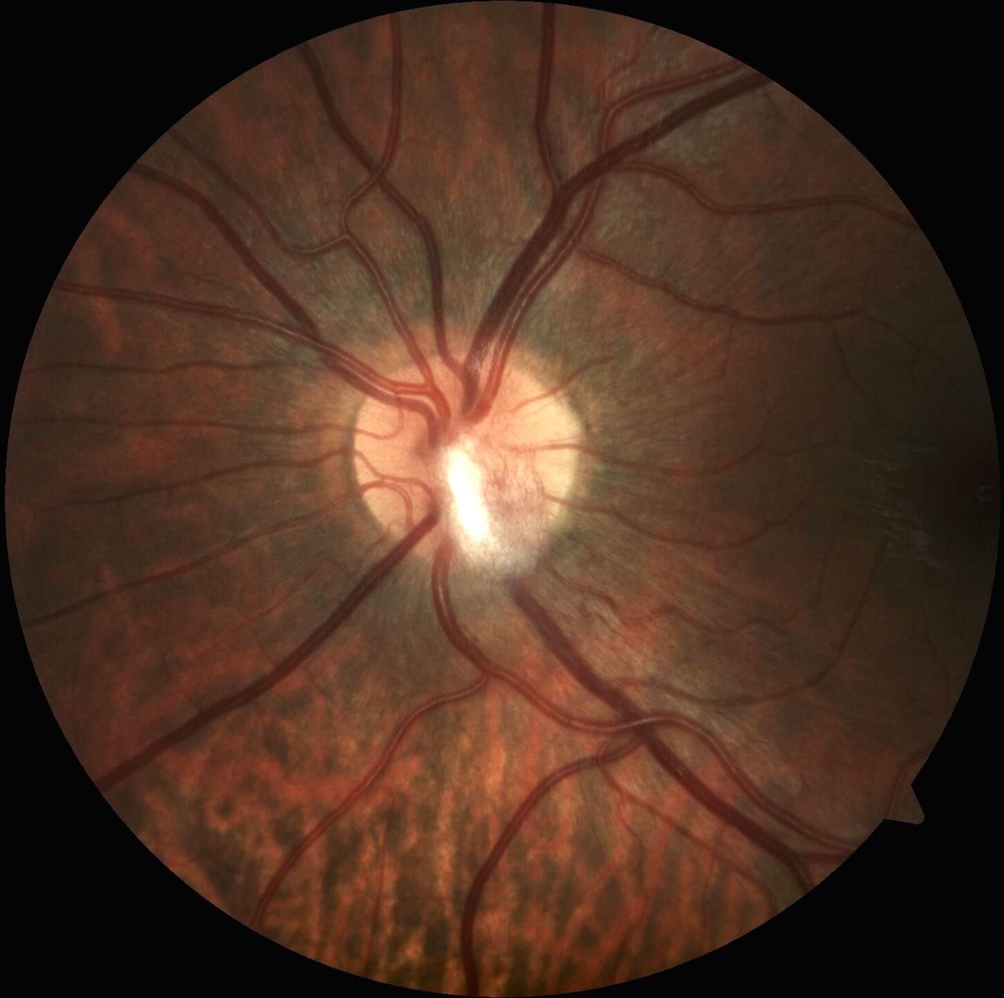 Colour fundus photography of the left eye in the patient’s daughter demonstrates a retinal capillary haemangioblastoma emanating from the optic nerve head.