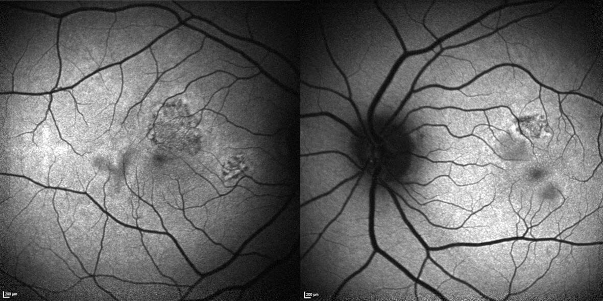 On fundus autofluorscence the lesions are centrally hypoautofluorescent with some hyperautofluorescent changes at the edges.