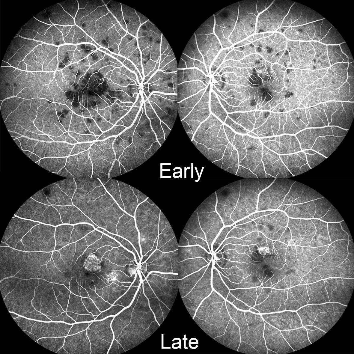 On fluorescein angiography the lesions are hypofluorescent early but hyperfluorescent in the late phases.