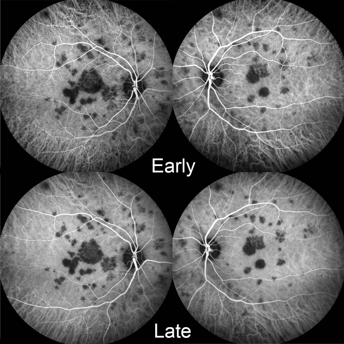 The lesions are hypofluorescent on indocyanine green angiography. They are much more extensive than seen on clinical examination (compare with Figure 1).