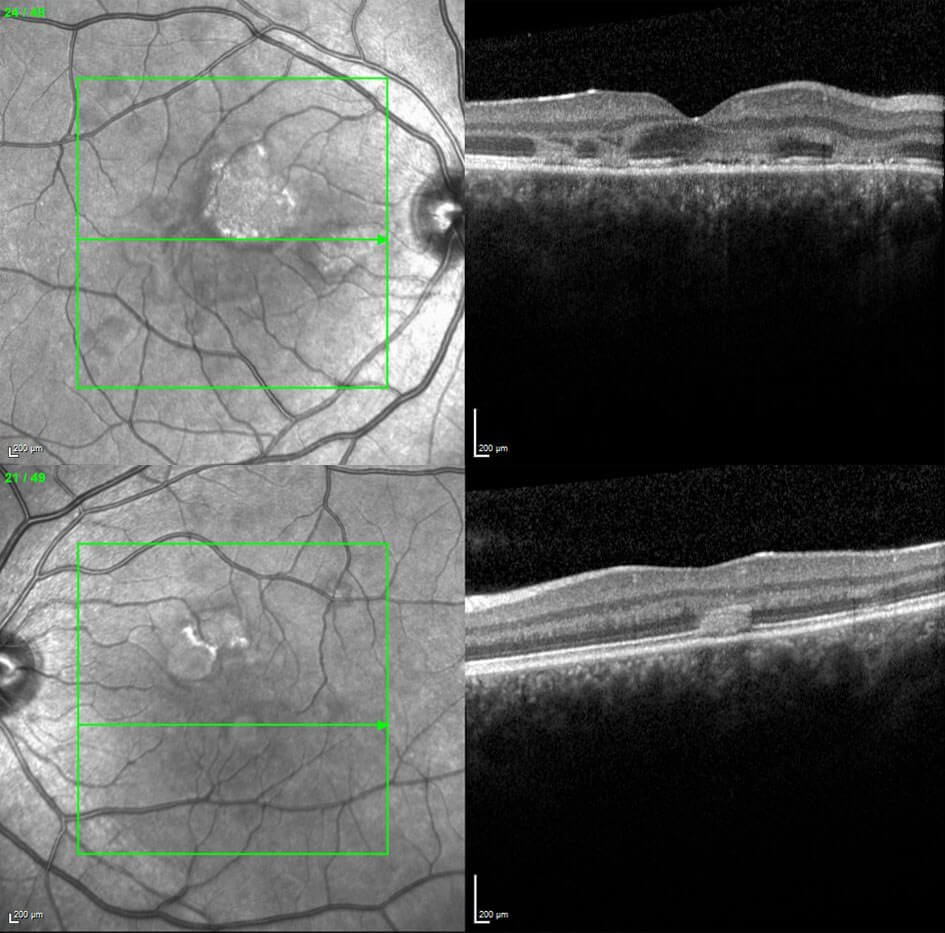 Optical coherence tomography shows the placoid lesions to be hyper-reflectivities in the outer nuclear layer, with disruption of the photoreceptors.