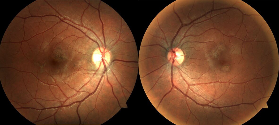 Three months after initial presentation the lesions are less prominent and have started to pigment.