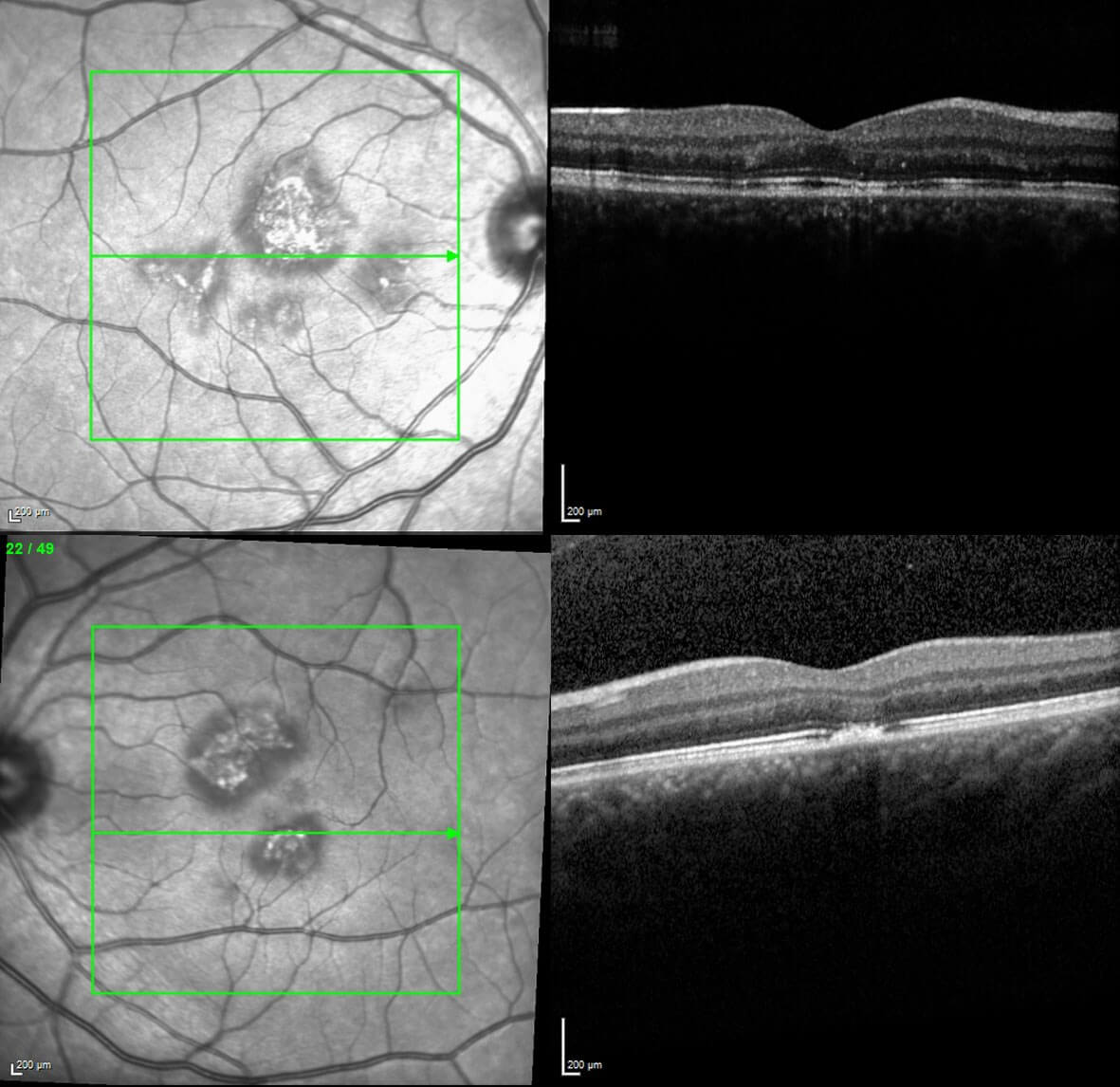 Three months after initial presentation the lesions are less prominent on optical coherence tomography.