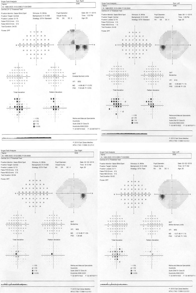 Humphrey visual fields at presentation (top images) and 3 months later (bottom images). The bilateral central scotomas have almost resolved during this time.