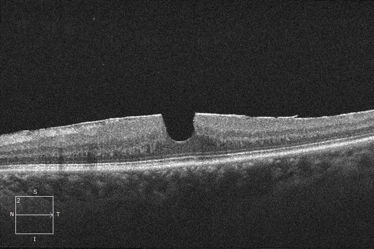 Optical coherence tomography through the fovea demonstrating the epiretinal membrane as a hyper-reflective layer on the surface of the retina and steepening of the foveal contour. Note the preservation of the foveal photoreceptors, particularly the integrity of the external limiting membrane and ellipsoid zone. These findings are consistent with a macular pseudohole.