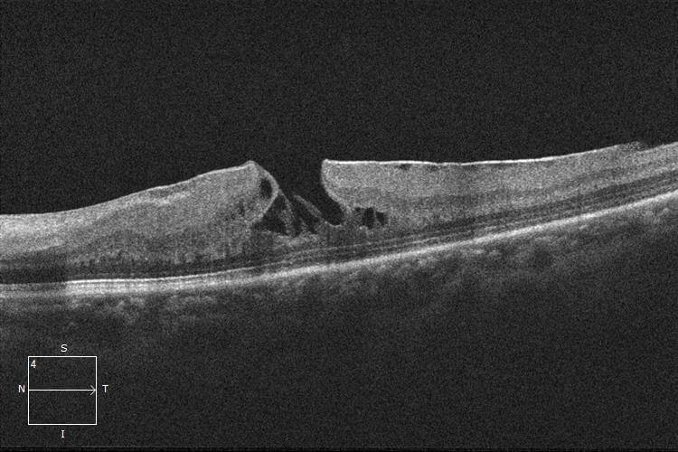 Optical coherence tomography demonstrating progression with the formation of an associated lamellar macular hole.