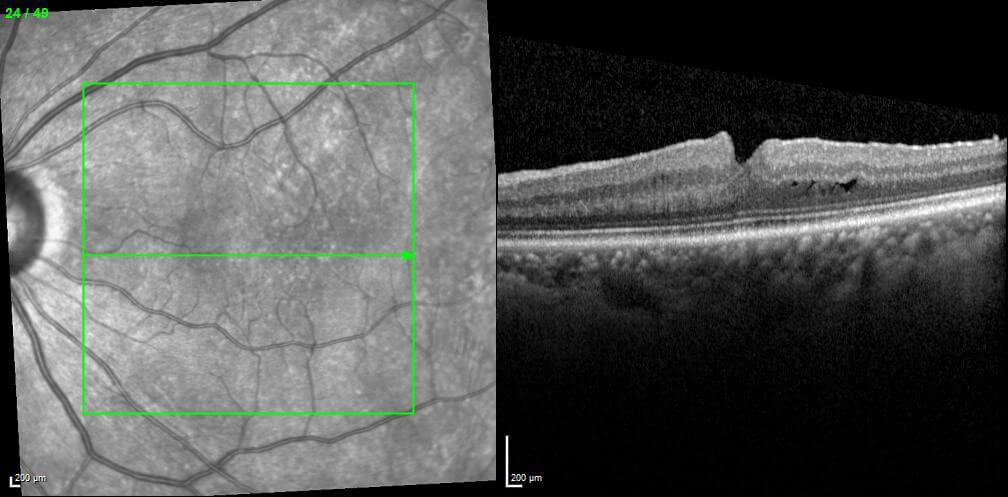 Postoperative optical coherence tomography at level of left fovea.