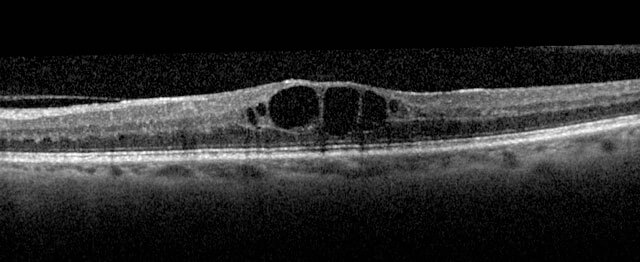 OCT demonstrates cystoid macular oedema