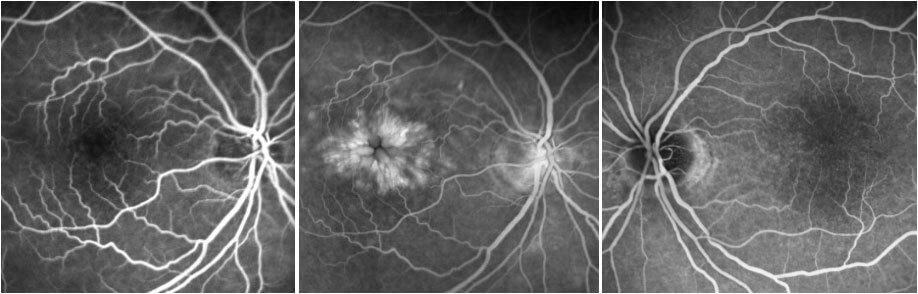 Fluorescein angiography demonstrated a petalloid pattern of leakage in the right macula and late disc staining. No diabetic vascular changes are seen. No disc staining is seen in the late image of the left eye.