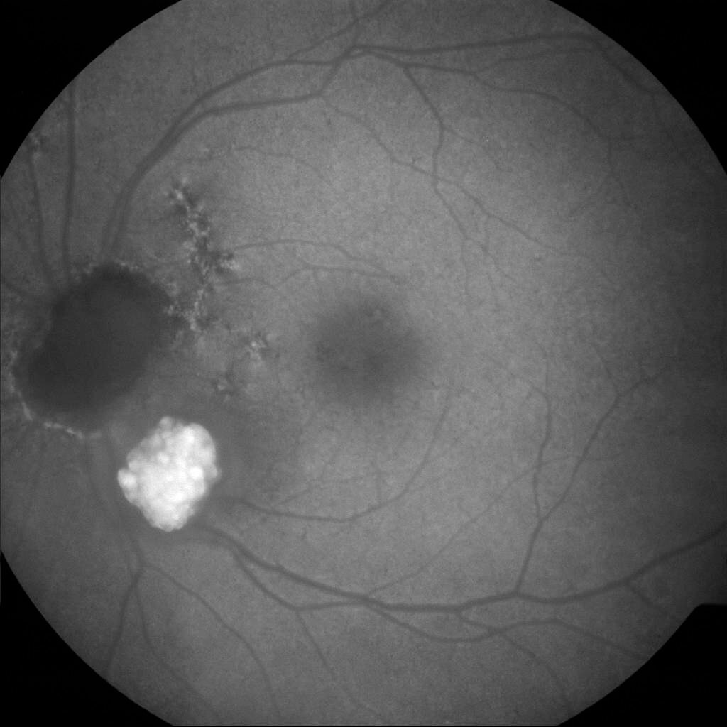 Fundus autofluorescence shows the lesion to be hyperautofluorescent. There are linear streaks emanating from near the optic disc.
