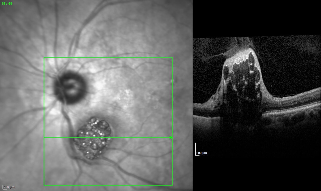 Left: Near infrared imaging shows the mulberry shaped lesion to have white “dots” interspersed throughout it. Right: On optical coherence tomography there are intralesional cavitations.